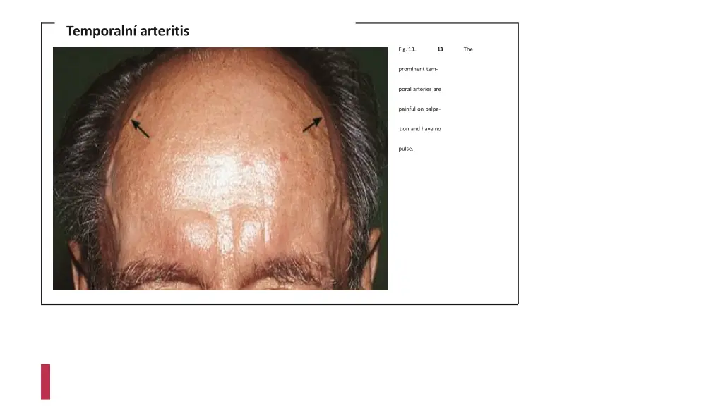 temporaln arteritis