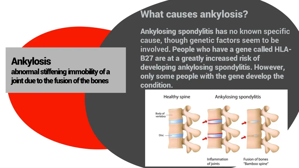 what causes ankylosis ankylosing spondylitis