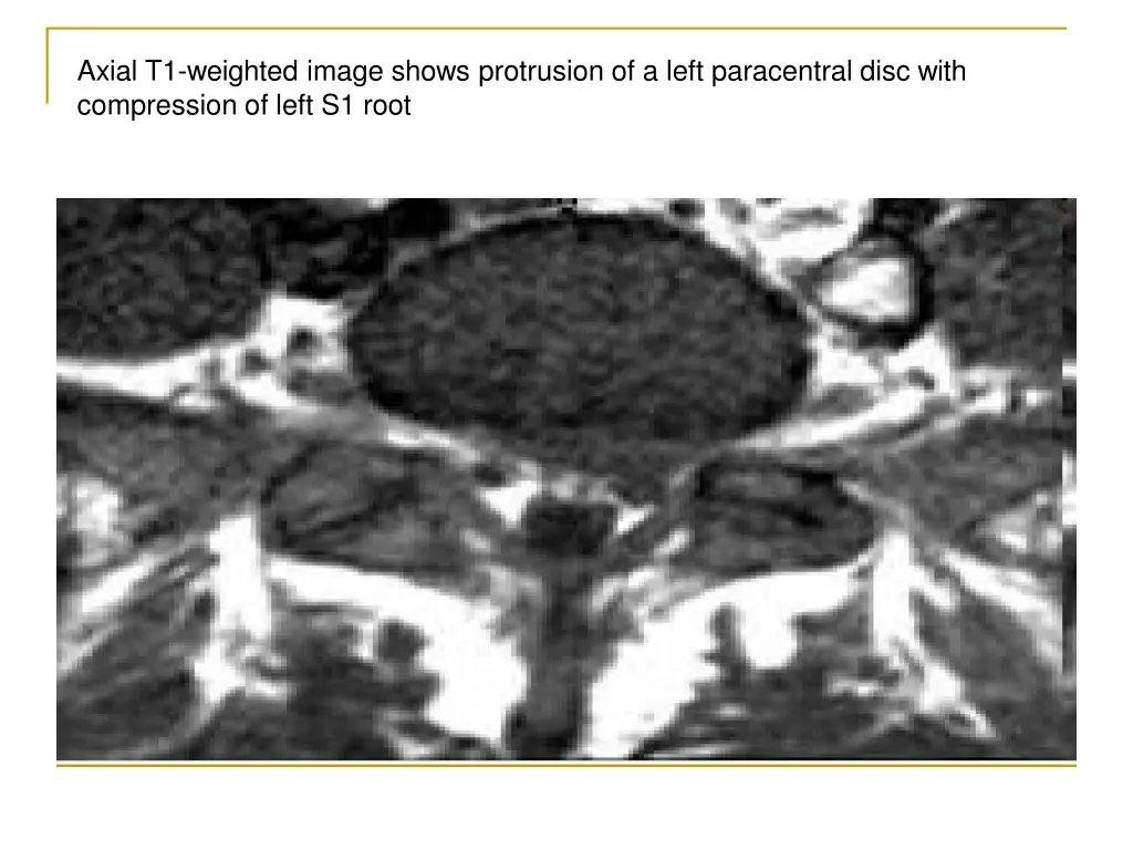 axial t1 weighted image shows protrusion