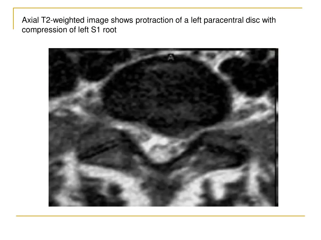 axial t2 weighted image shows protraction