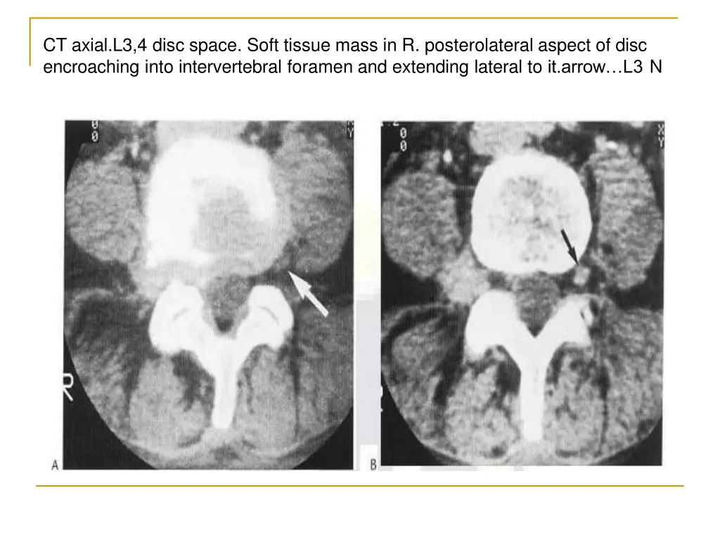 ct axial l3 4 disc space soft tissue mass