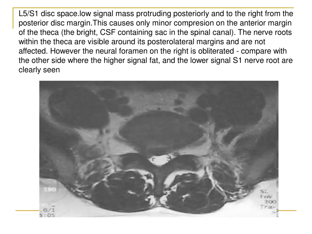 l5 s1 disc space low signal mass protruding