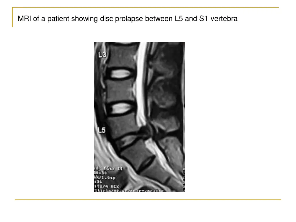 mri of a patient showing disc prolapse between