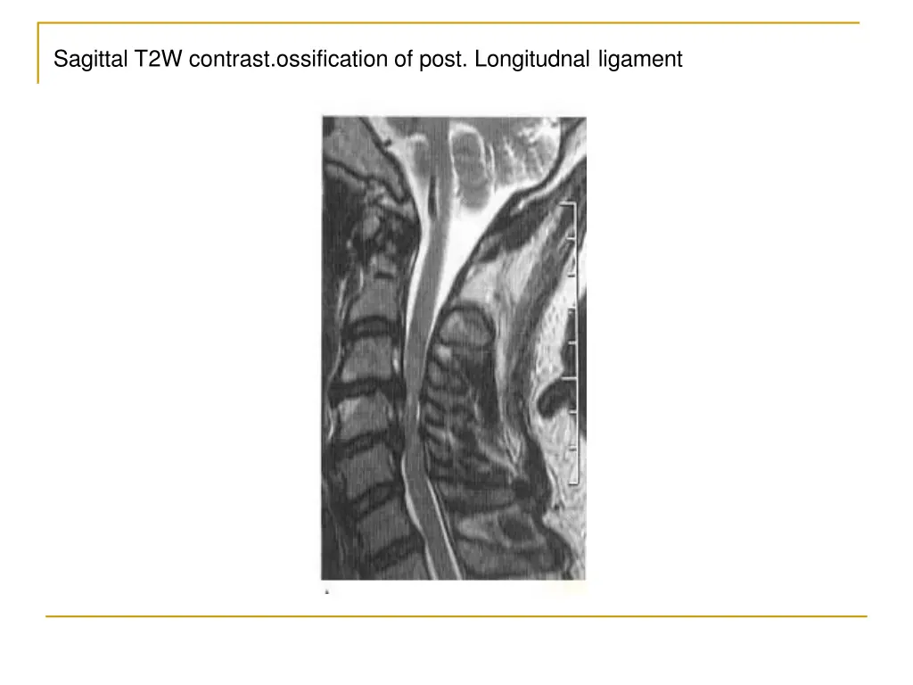 sagittal t2w contrast ossification of post