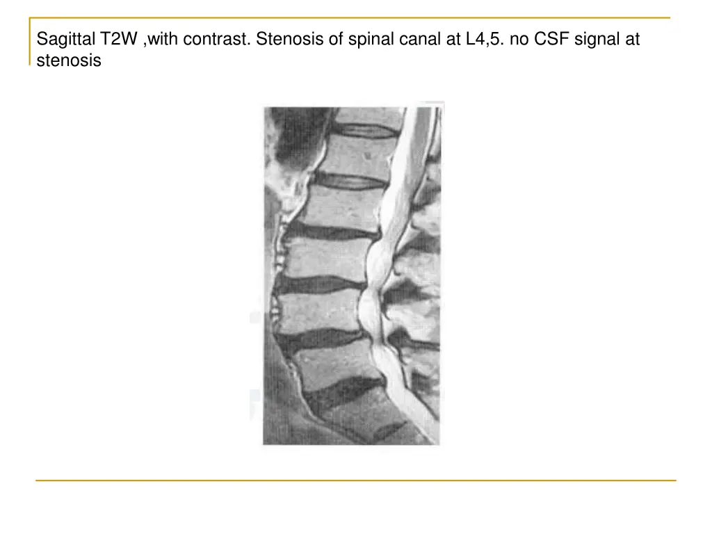 sagittal t2w with contrast stenosis of spinal