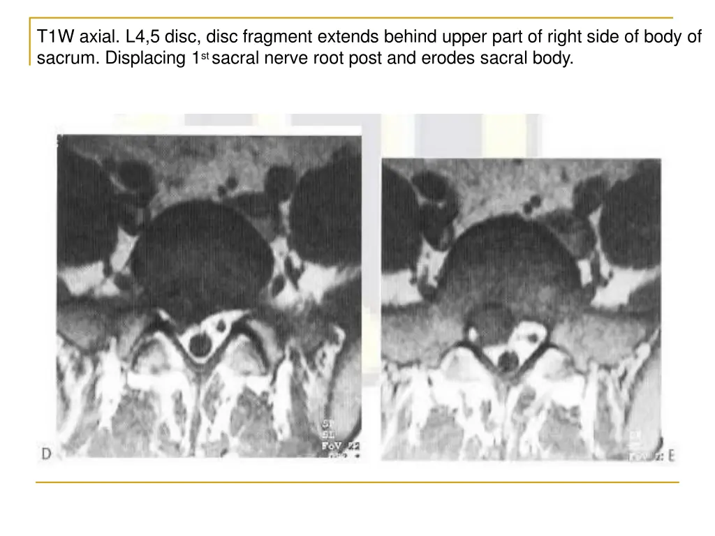 t1w axial l4 5 disc disc fragment extends behind