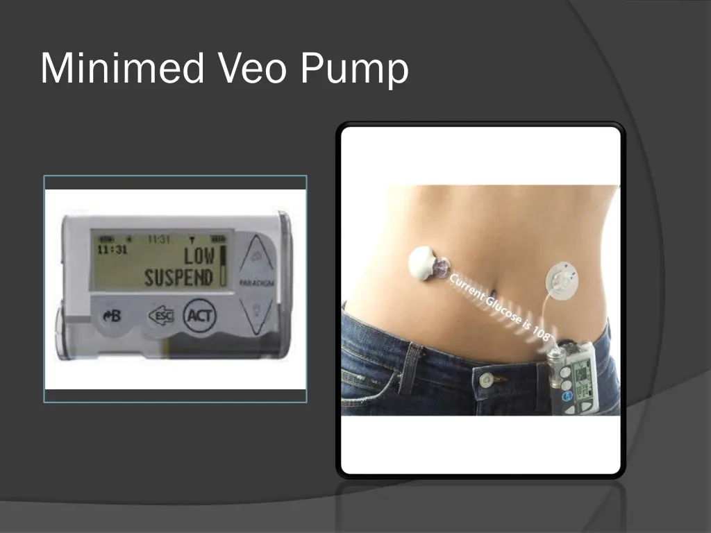 minimed veo pump