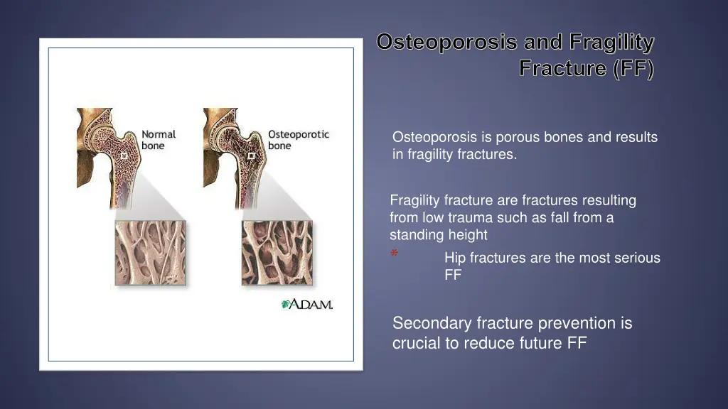 osteoporosis and fragility