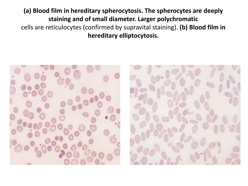 a blood film in hereditary spherocytosis