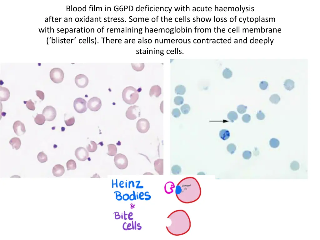 blood film in g6pd deficiency with acute