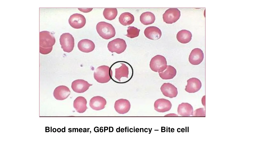 blood smear g6pd deficiency bite cell