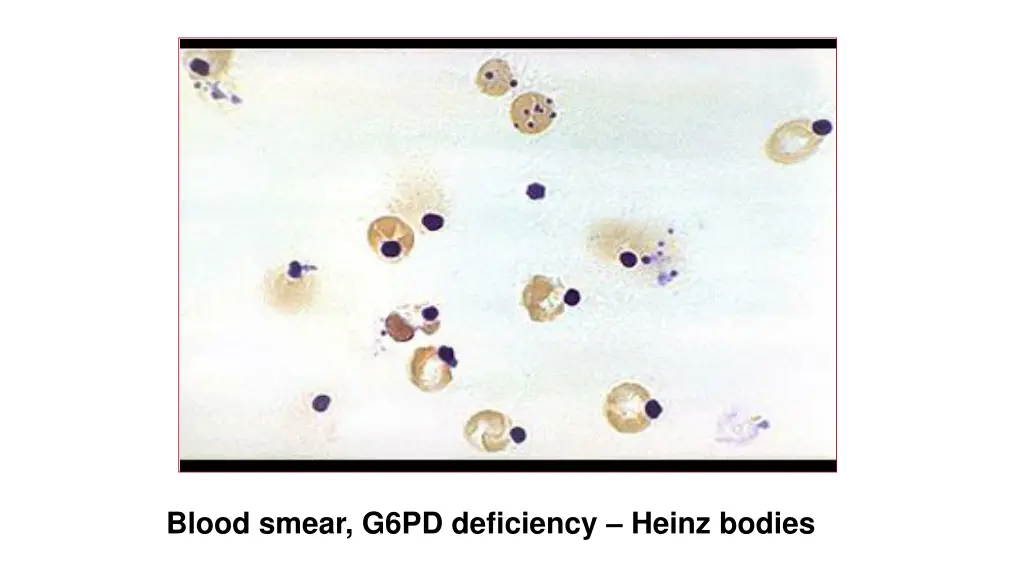 blood smear g6pd deficiency heinz bodies