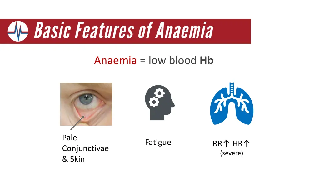 anaemia low blood hb