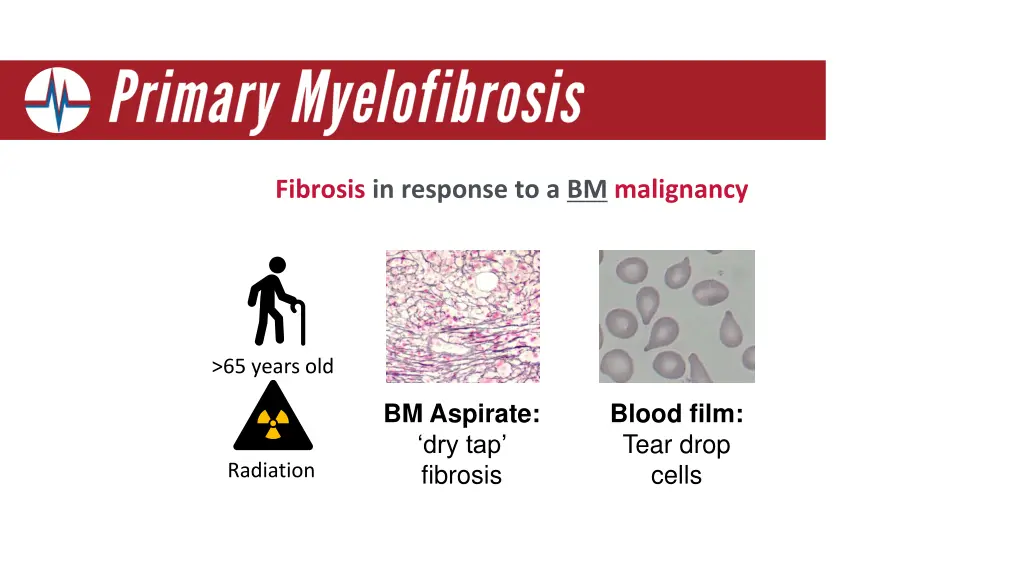 fibrosis in response to a bm malignancy