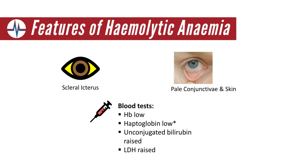 scleral icterus