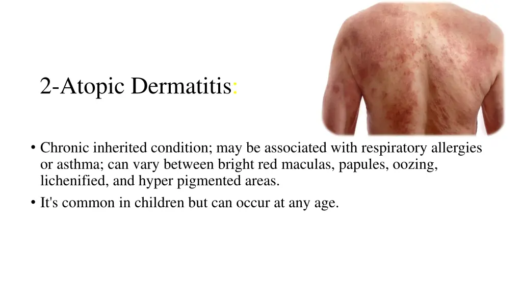 2 atopic dermatitis