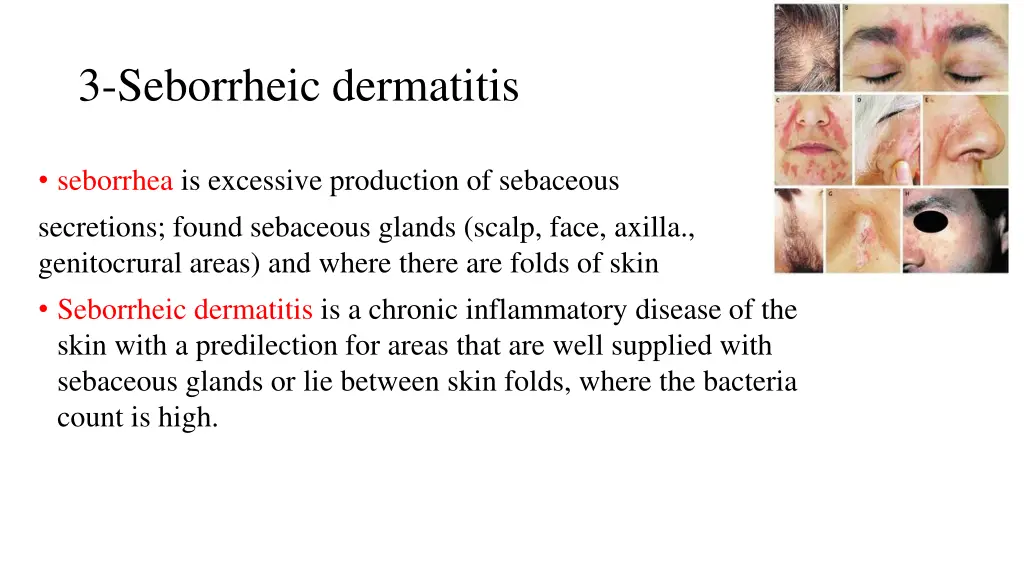 3 seborrheic dermatitis