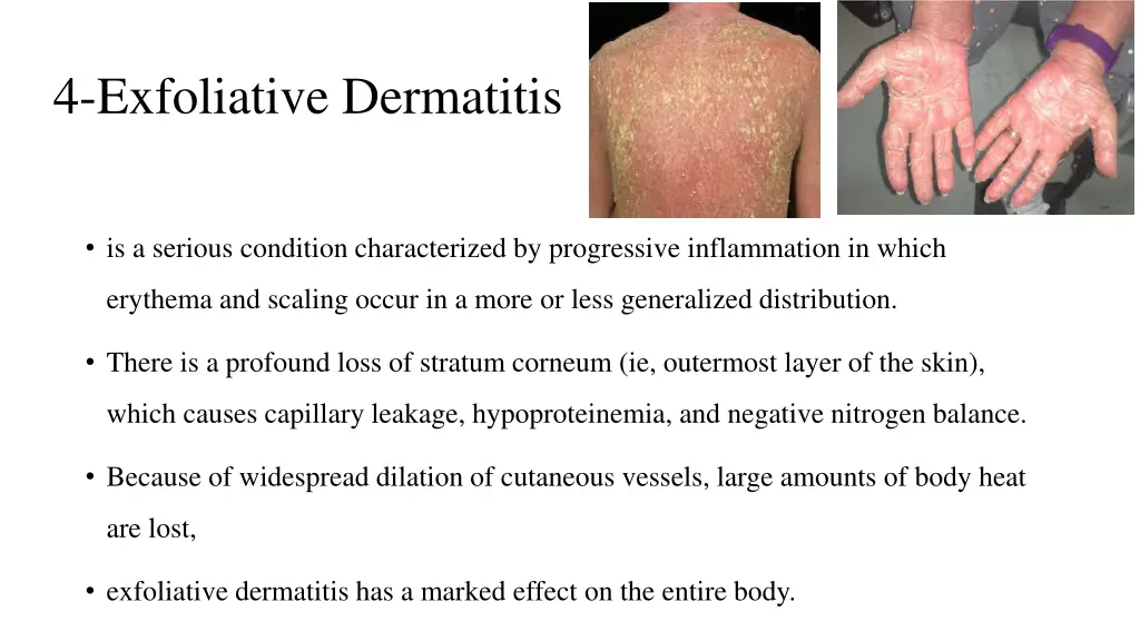 4 exfoliative dermatitis