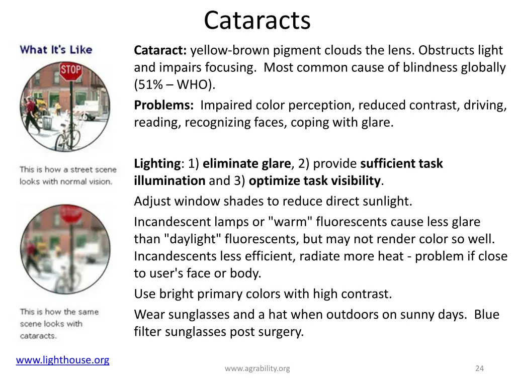 cataracts