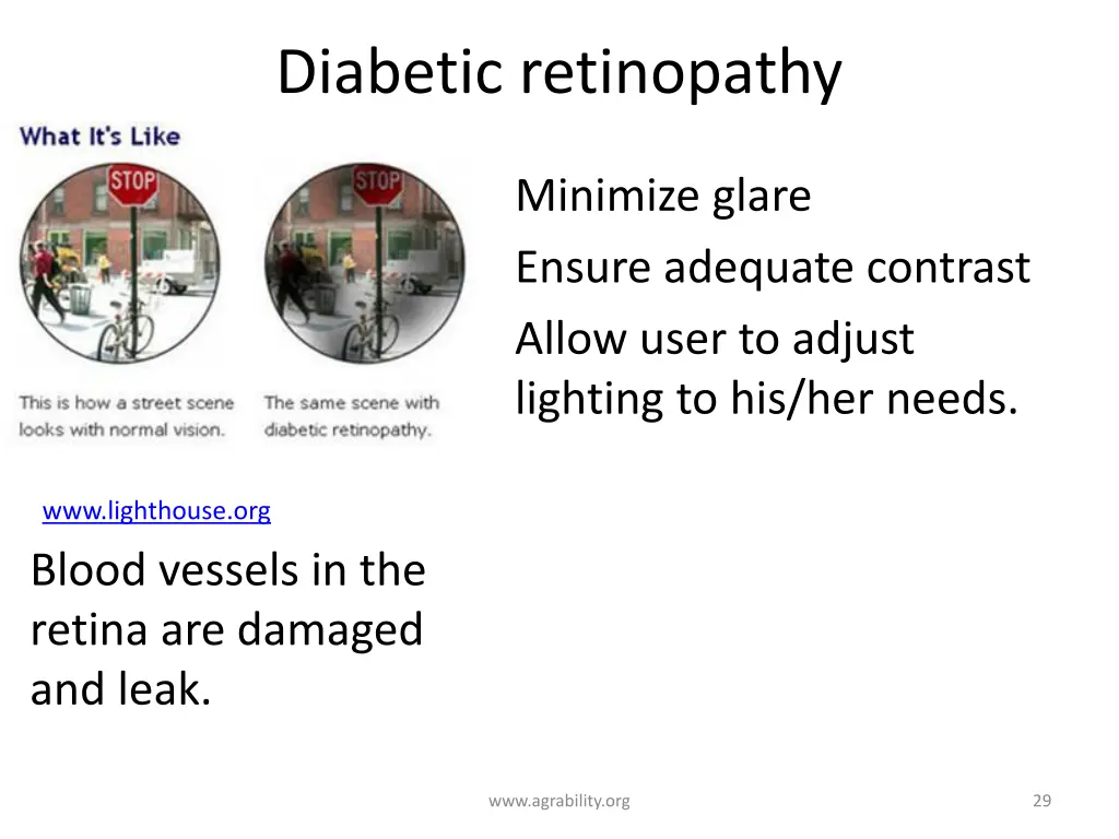 diabetic retinopathy