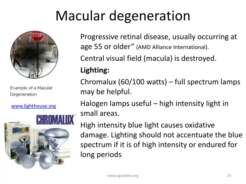 macular degeneration