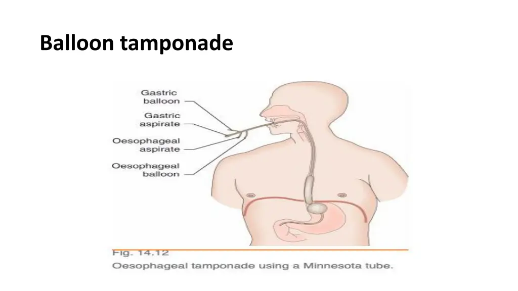 balloon tamponade