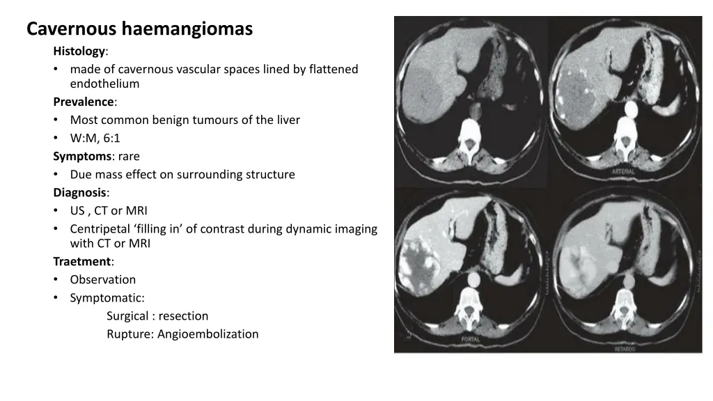 cavernous haemangiomas histology made