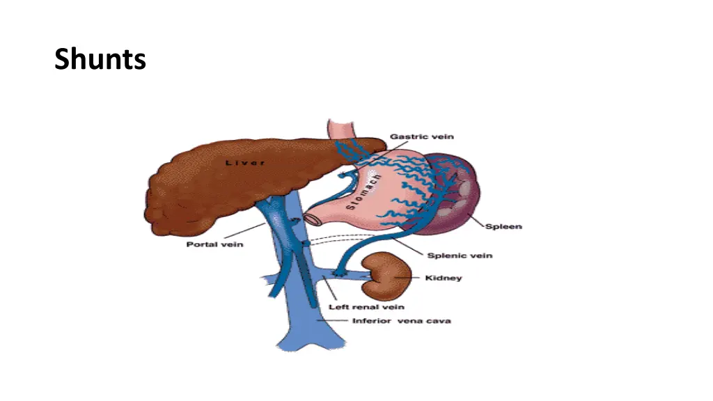 shunts