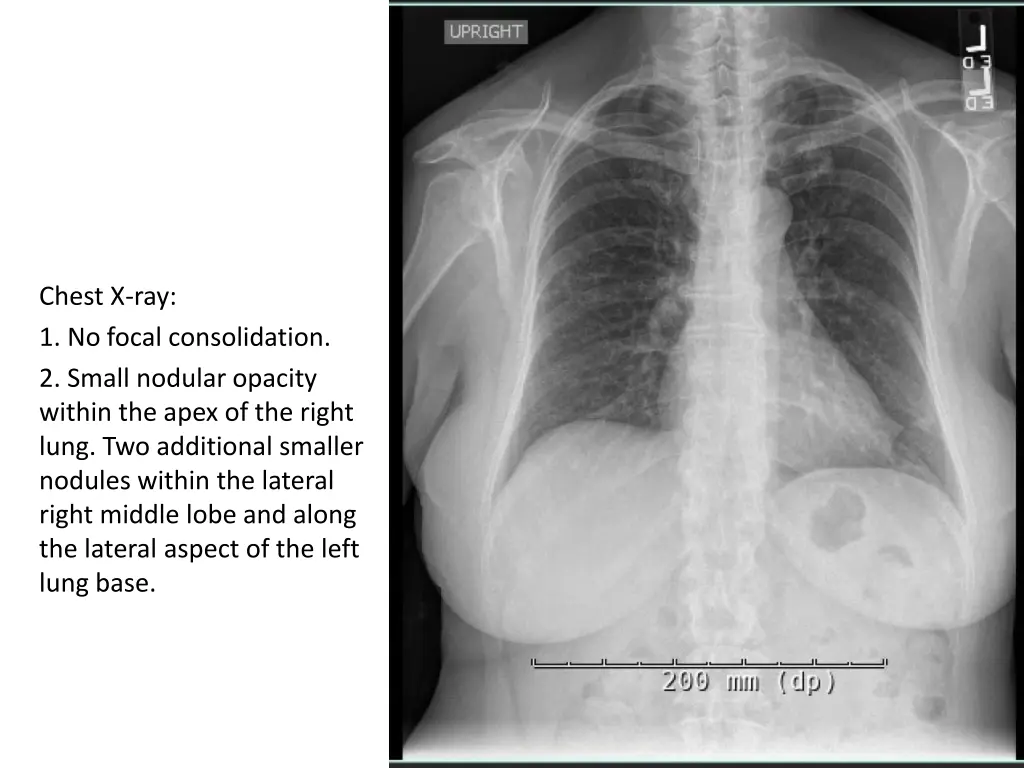 chest x ray 1 no focal consolidation 2 small