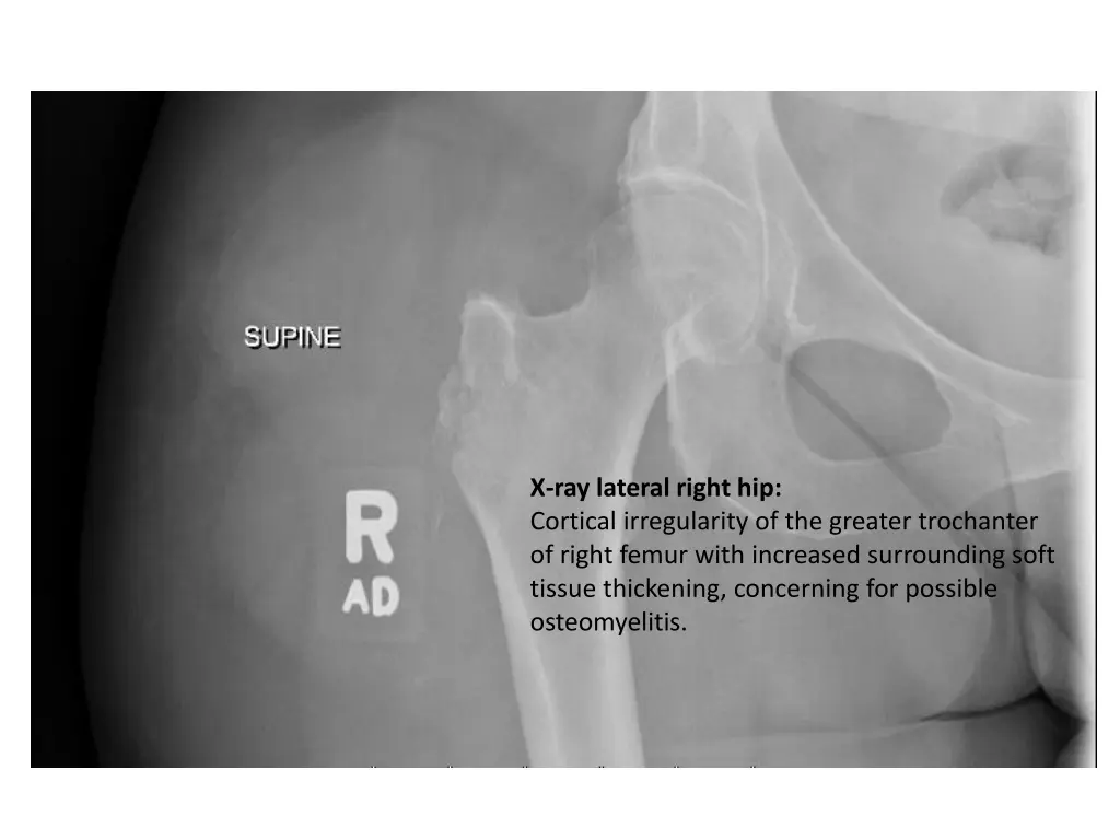 x ray lateral right hip cortical irregularity