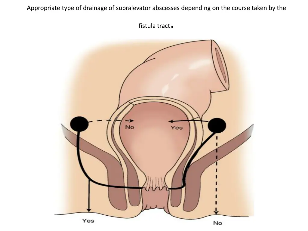 appropriate type of drainage of supralevator