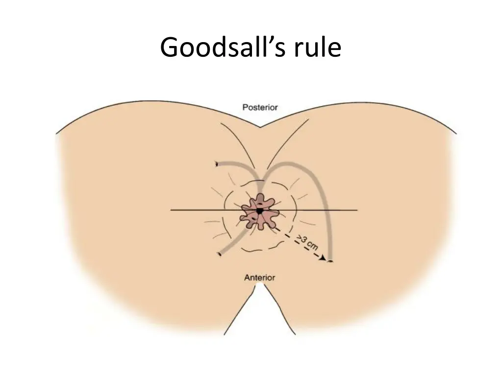 goodsall s rule