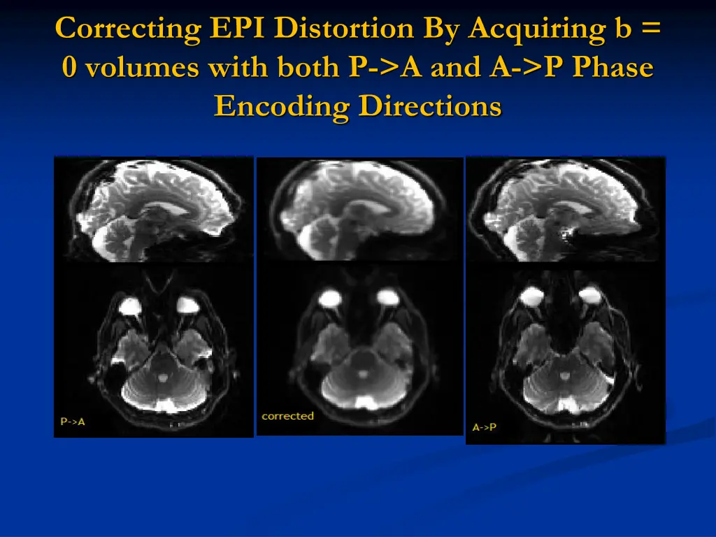 correcting epi distortion by acquiring