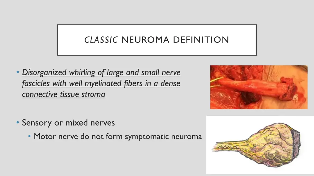 classic neuroma definition