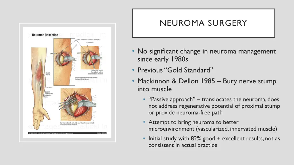 neuroma surgery