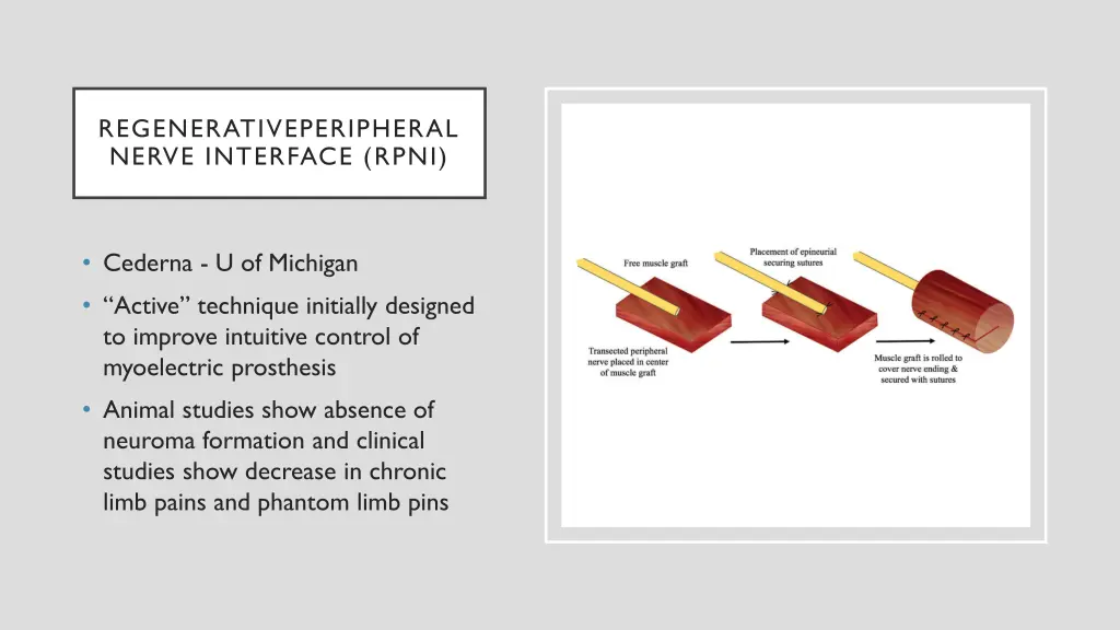 regenerativeperipheral nerve interface rpni