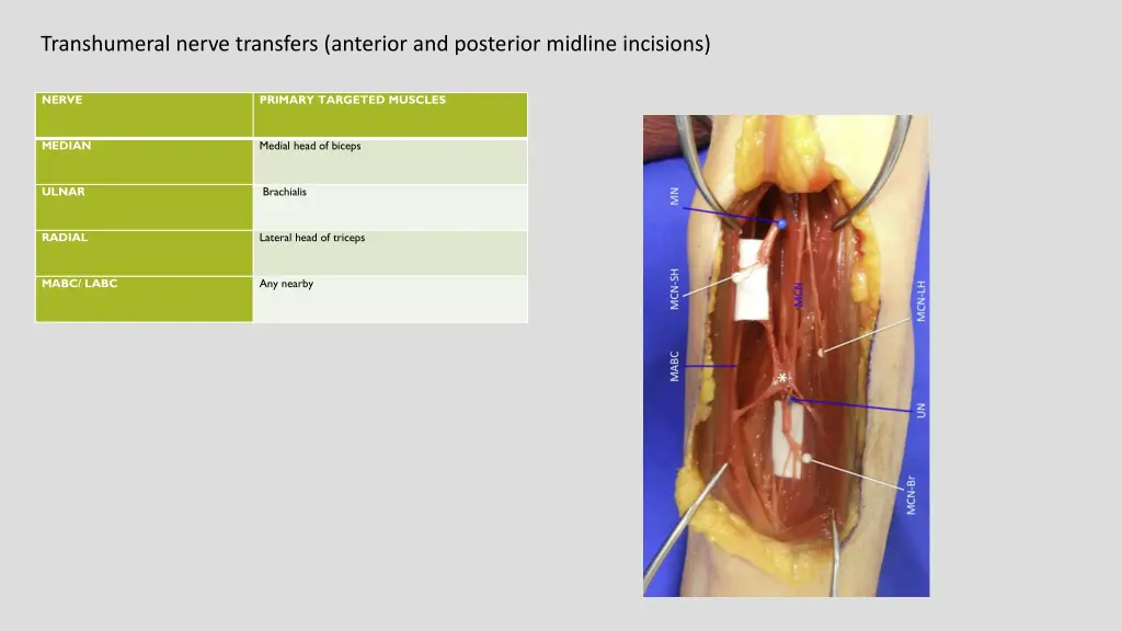 transhumeral nerve transfers anterior