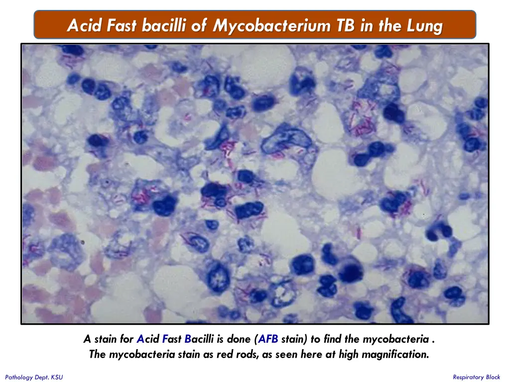 acid fast bacilli of mycobacterium tb in the lung