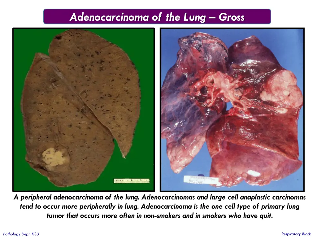 adenocarcinoma of the lung gross