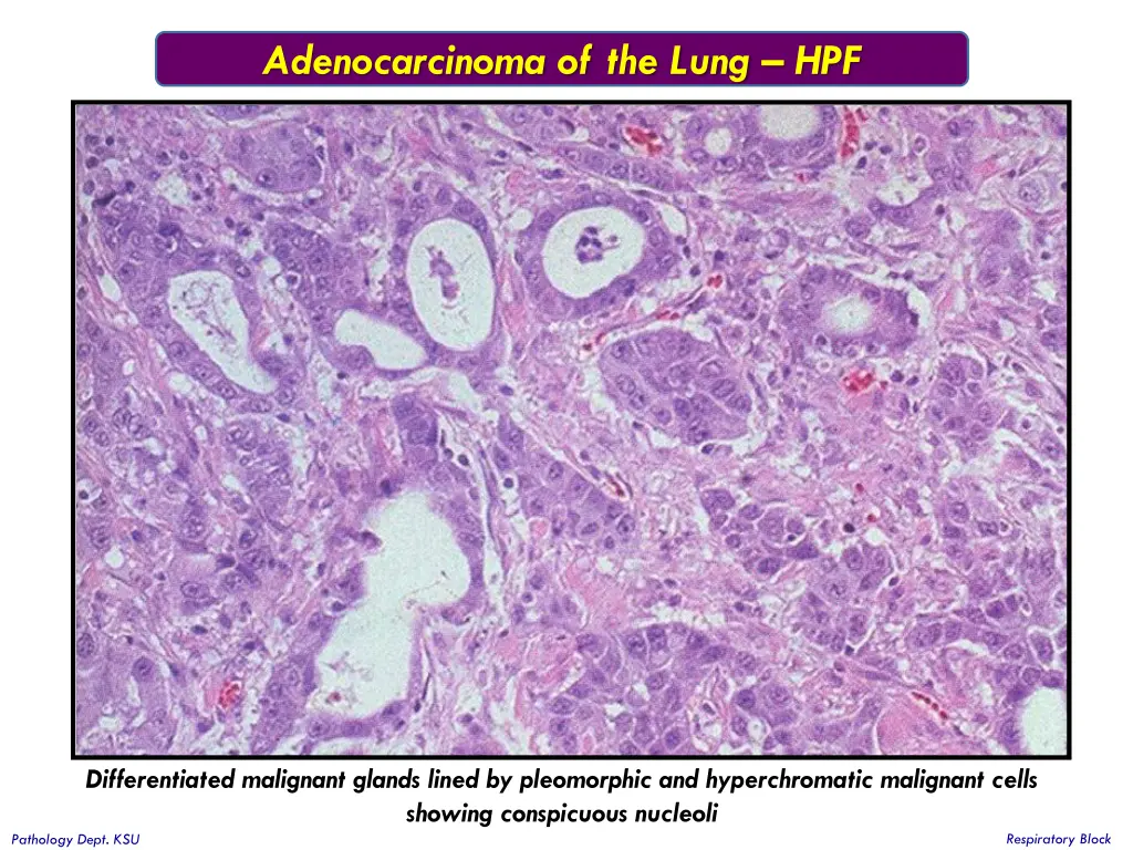 adenocarcinoma of the lung hpf 1