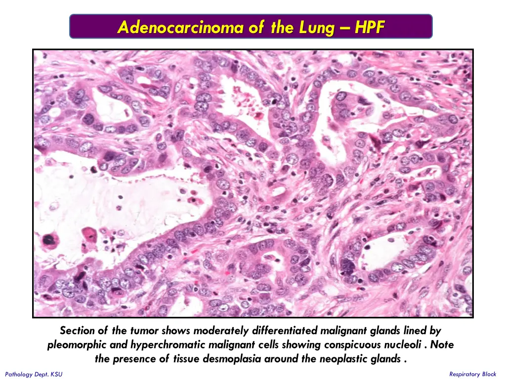 adenocarcinoma of the lung hpf