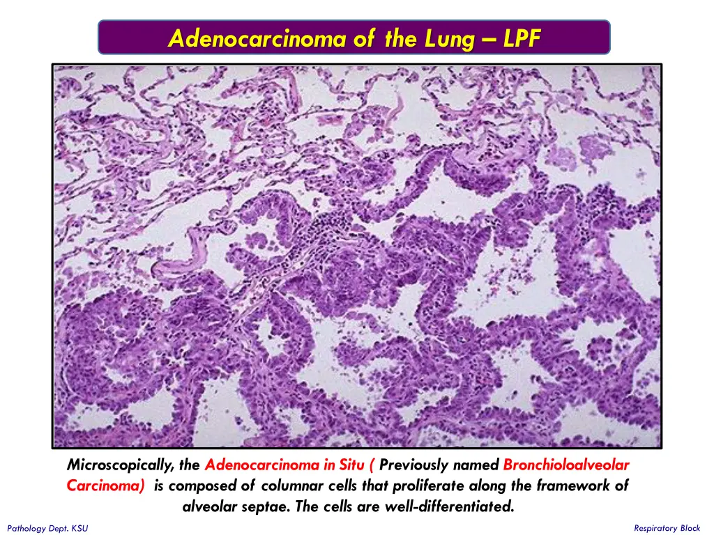 adenocarcinoma of the lung lpf