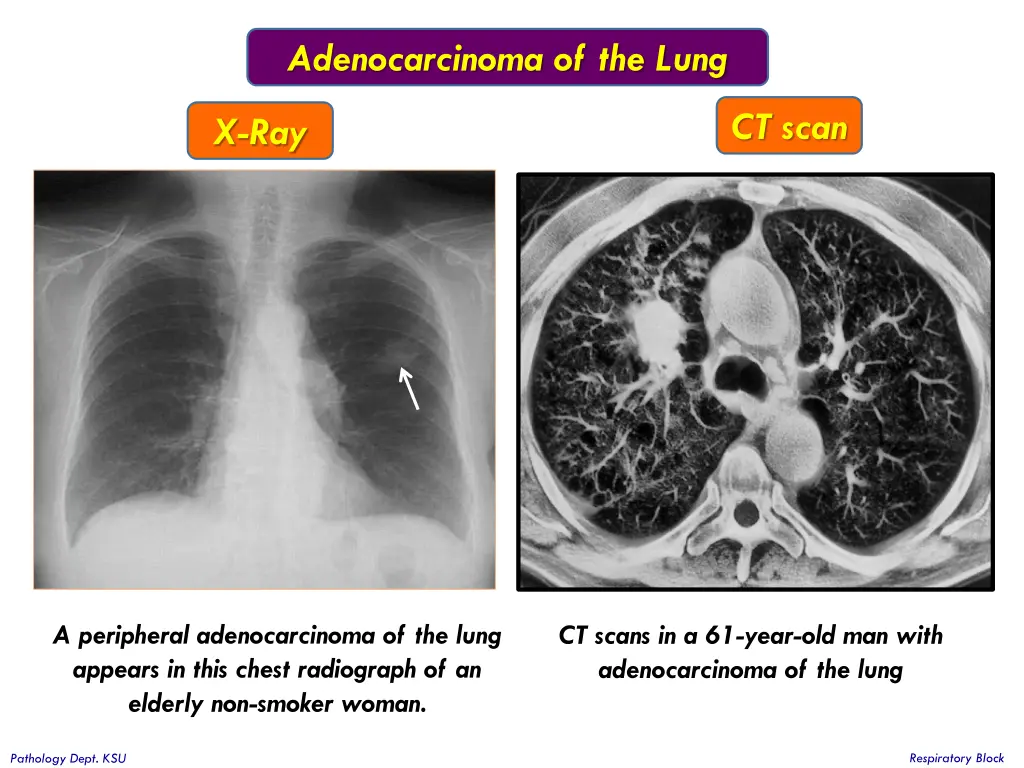 adenocarcinoma of the lung