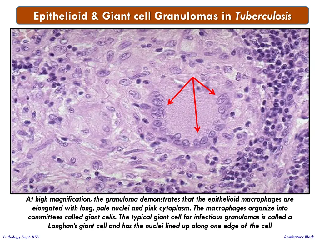 epithelioid giant cell granulomas in tuberculosis