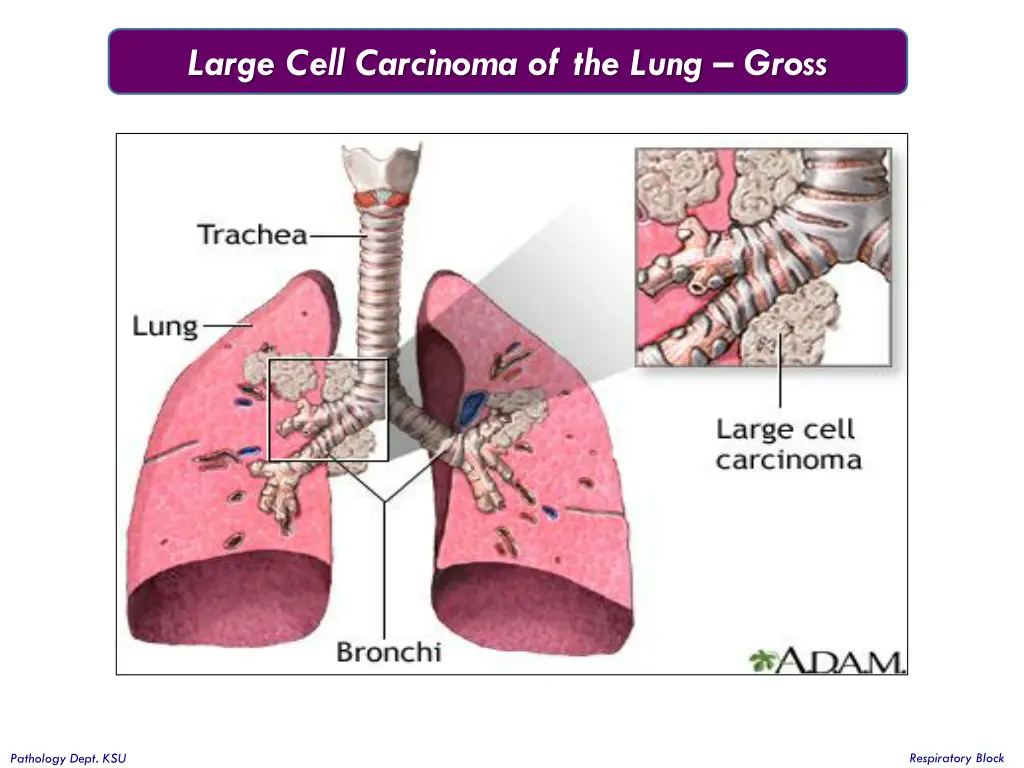 large cell carcinoma of the lung gross