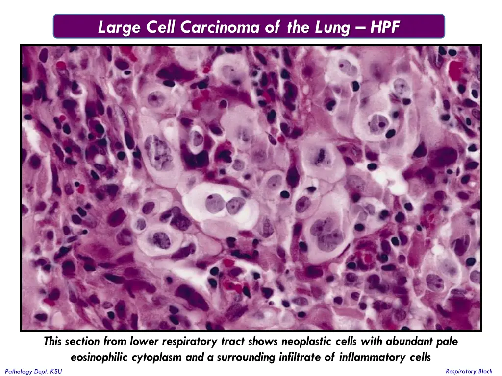 large cell carcinoma of the lung hpf 1