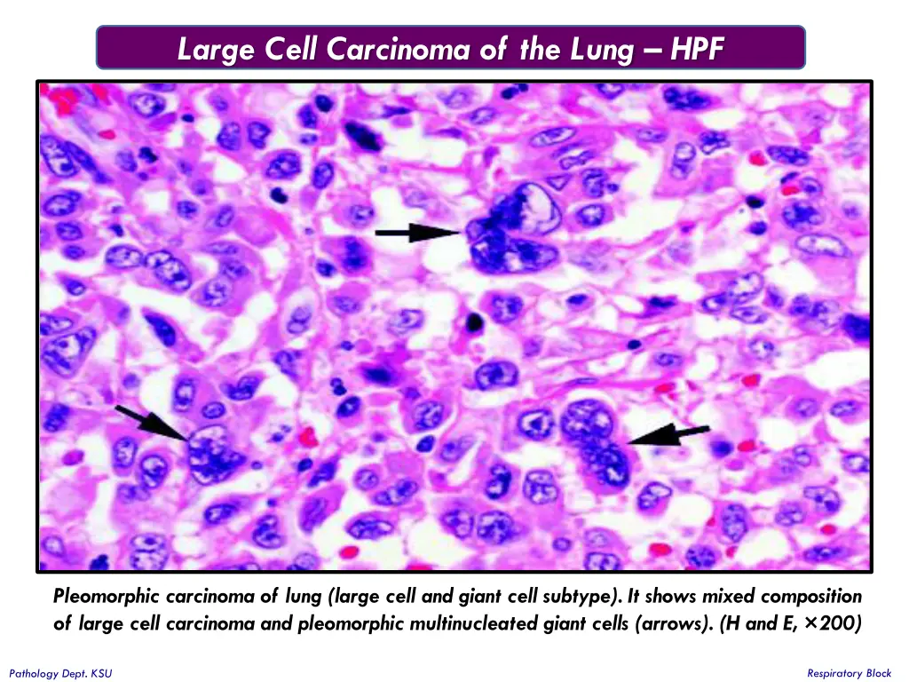 large cell carcinoma of the lung hpf