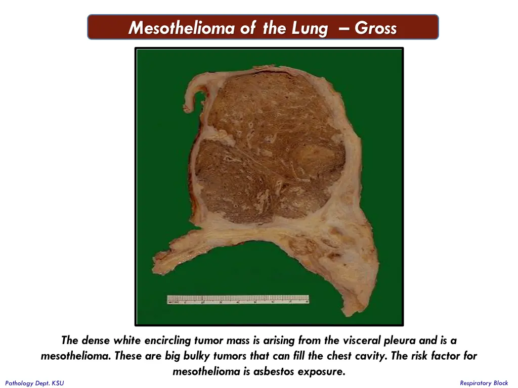 mesothelioma of the lung gross