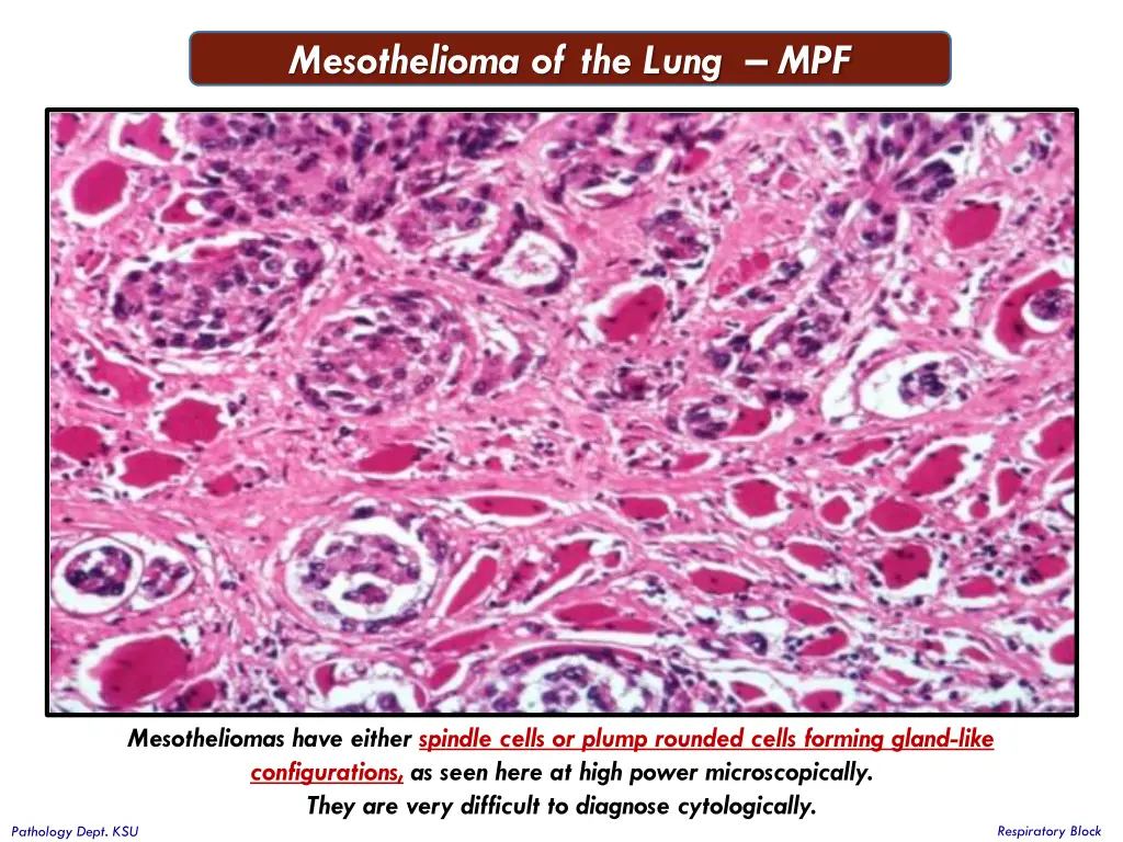 mesothelioma of the lung mpf