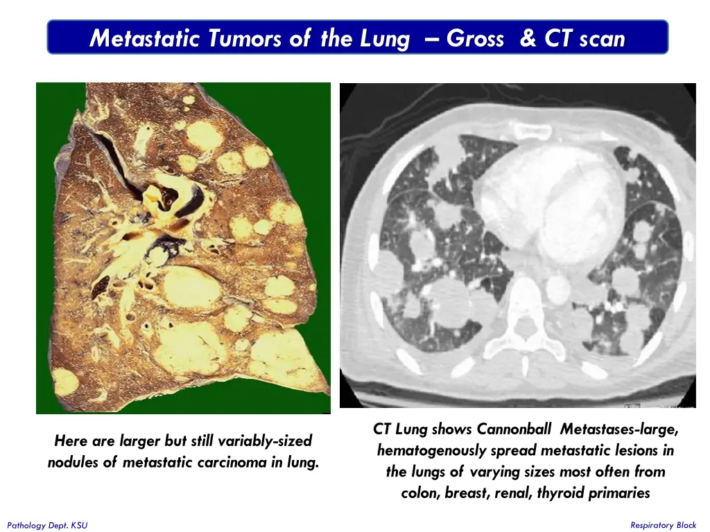 metastatic tumors of the lung gross ct scan